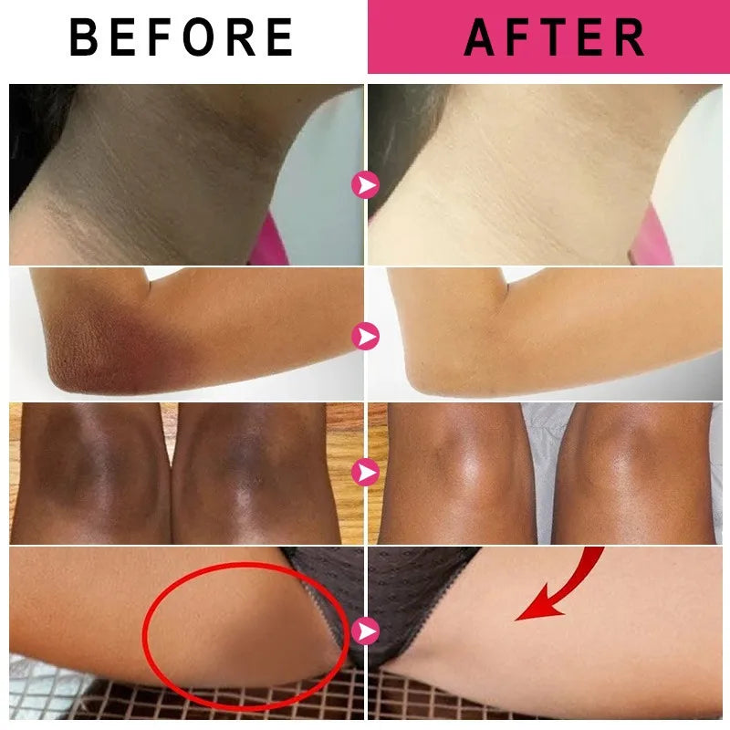 Inner Thigh Brightening Cream Private Parts Lighten Cream Intimate Area Armpit Knee Bleach Emulsion Underarm Brighten Skin Care.Crema iluminadora para el interior del muslo, crema para aclarar partes privadas